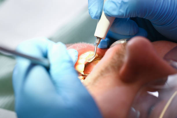 Best Emergency Root Canal Treatment in Lewisburg, KY